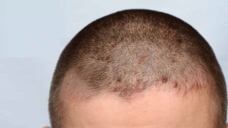 La dermatite séborrhéique provoque-t-elle une perte de cheveux ?